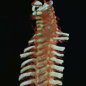 Human Cadaver Dissection Showing the Arteries of the Vertebral Column 