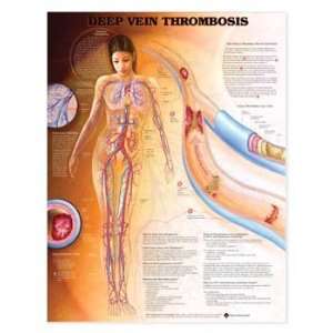Understanding Deep Vein Thrombosis   Paper  Industrial 